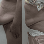 caso-exito-hernia-abdominal-1