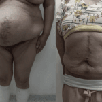 caso-exito-hernia-abdominal-2