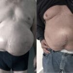 caso-exito-hernia-abdominal-3