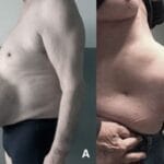 caso-exito-hernia-abdominal-4