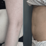 caso-exito-hernia-abdominal-5