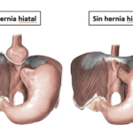 hernia-hiatal-4