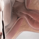 hernia-inguinal-4