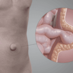 hernia-umbilical-1